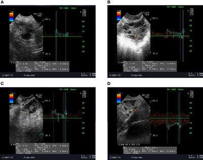 Variations in the Profiles of Vascular-Related Factors Among Different Sub-Types of Polycystic Ovarian Syndrome in Northern China